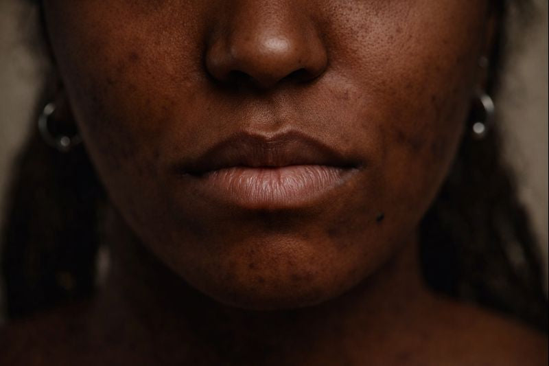 Waarom huidverbetering bij een melanine-rijke huid begint met kennis en rust
