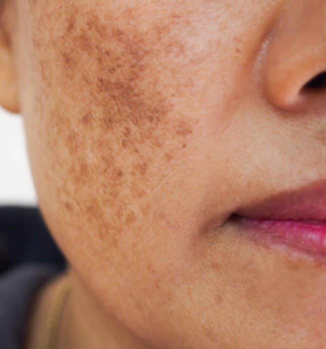 Melanin Moments: Hyperpigmentatie ontrafeld – waarom komt het zo vaak voor?