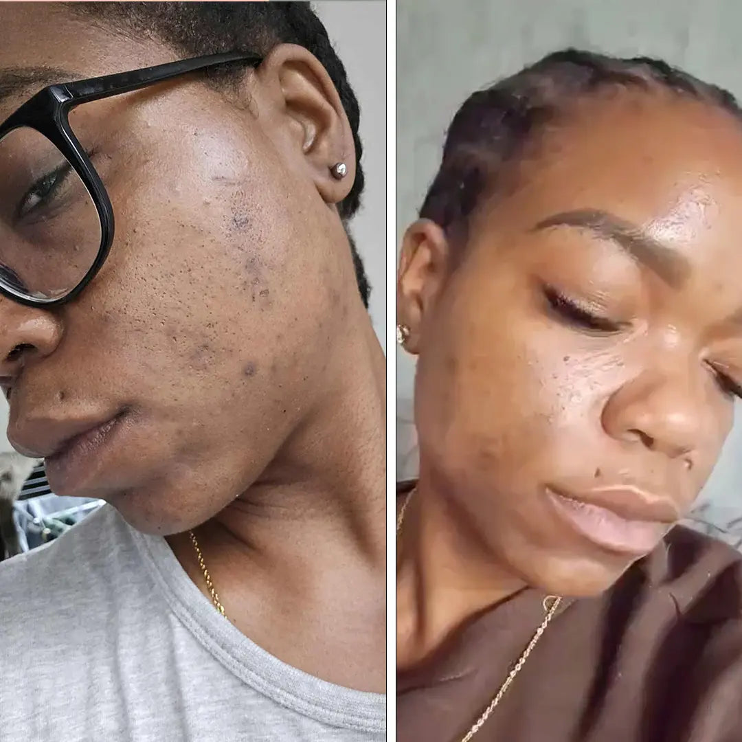 Total Bye Hyperpigmentation Package